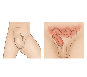 샅(서혜)헤르니아