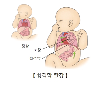횡격막 탈장