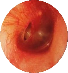 외상에 의한 고막 천공